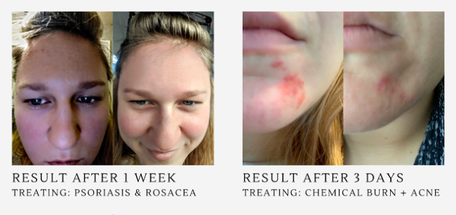 Is Rosacea caused by liver congestion... 5